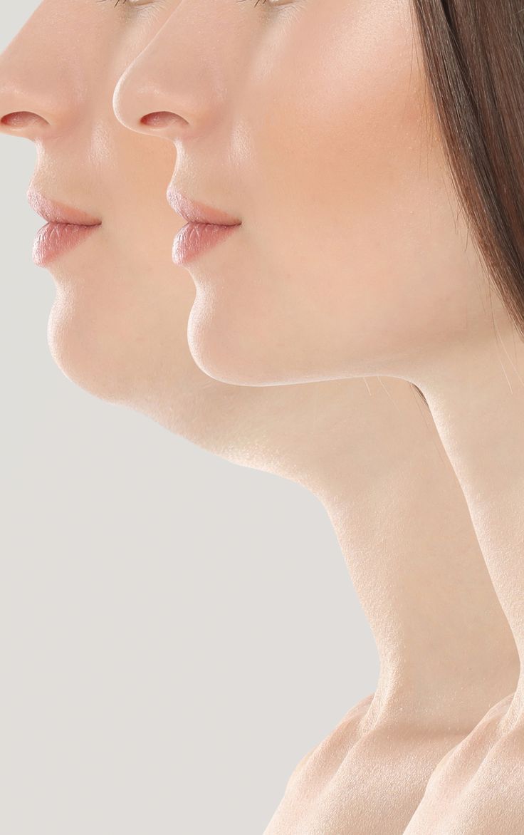 Double Chin Liposuction