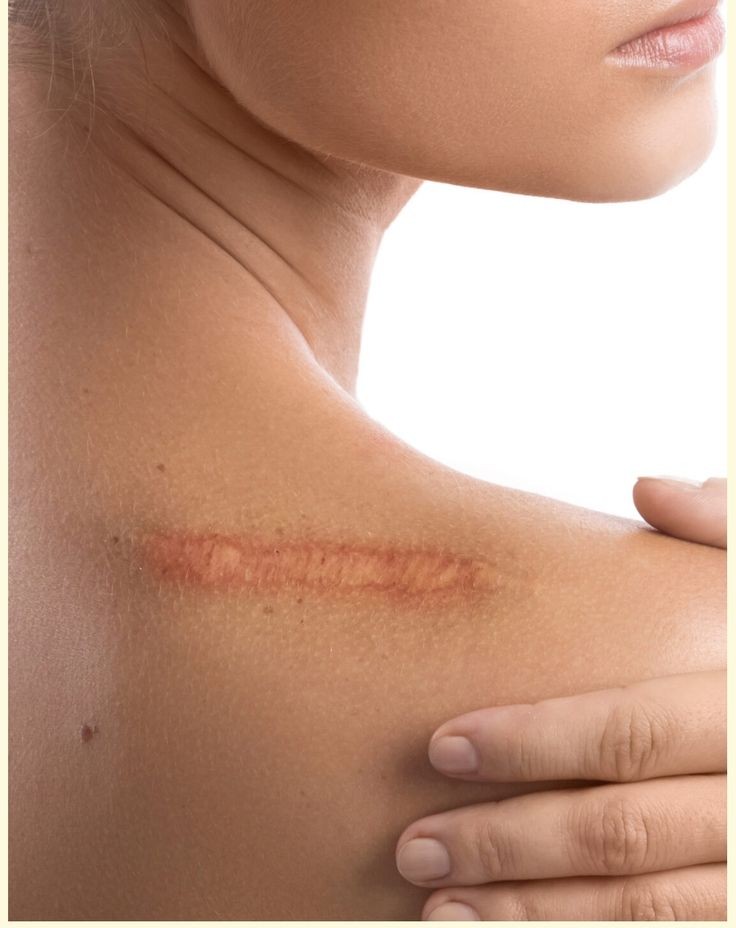 Scar Revision